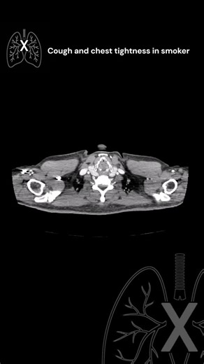 Andi Sukthi MD | Interventional Pulmonology and Respiratory Med on Instagram: "🫁 Enhancing Lung Cancer Diagnosis and Staging with EUS-B Endoscopic ultrasound using the EBUS scope (EUS-B) is gaining recognition as a valuable addition to the diagnostic arsenal for lung cancer, particularly non-small cell lung cancer (NSCLC). Traditionally, endobronchial ultrasound-guided transbronchial needle aspiration (EBUS-TBNA) has been the cornerstone for mediastinal lymph node sampling. However, comb