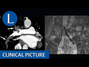 Thromboses and thrombocytopenia after ChAdOx1 nCoV-19 vaccination