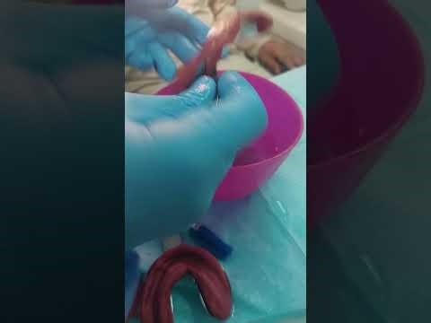 primary impression for complete denture with impression compound (شرح on patient)