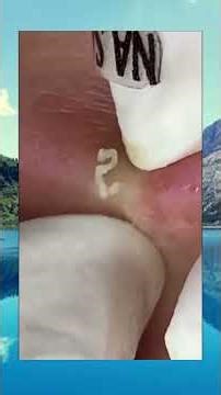 Endless blackhead pops!