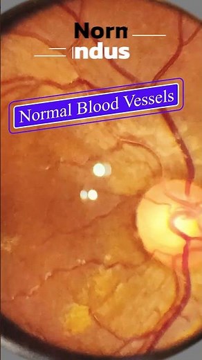 Normal fundus | Smartphone Fundus Videography | Fundus Photography | Short Video 501
