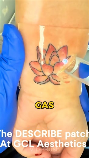 This tiny patch makes tattoo removal way more effective. #tatoo #removetattoo