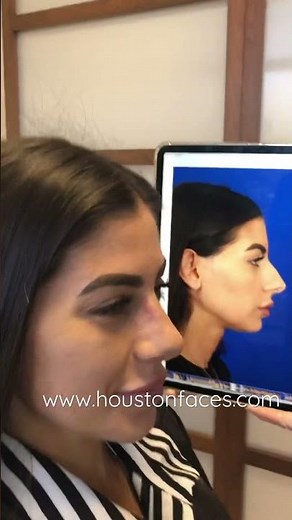 Before And After Rhinoplasty Transformation By Houston Nose Surgeon Dr. Michel Siegel!