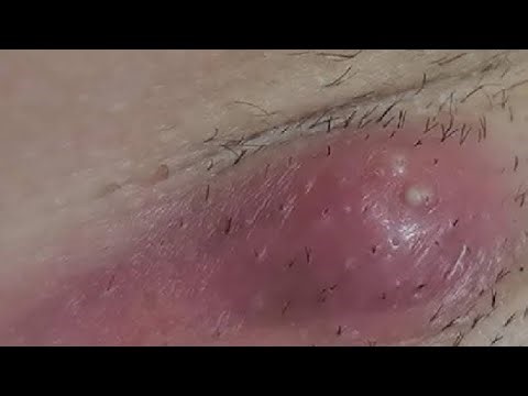 BOIL REMOVAL ULTIMATE TIPS