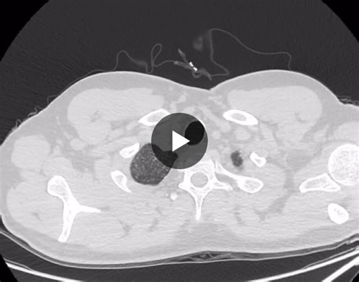 HRCT Challenge: Micronodular Lung Disease Diagnosis | Khaled Abuzeid posted on the topic | LinkedIn