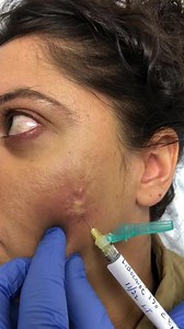 Keloid injection with kenalog