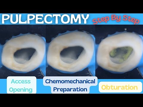 Pulpectomy ⚪️ Step By Step Demonstration 🔵 Baby Blue Pediatric Rotary Endodontic Files