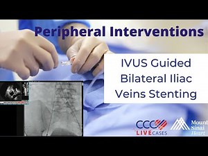 IVUS Guided Bilateral Iliac Veins Stenting - September 16, 2015 Live Case Video
