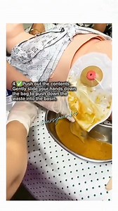How to empty Patients Colostomy Bag One of the most kindest care in Nursing. Every Nurse should learn | Brilliant Nurses
