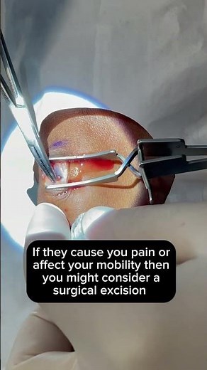 Ganglion Cyst Surgery Removal