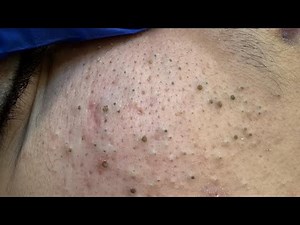 The ULTIMATE Blackhead Removal & Cleansing Techniques | Doctorly Routines