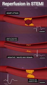 37K views · 140 reactions | STEMI: From Occlusion to Reperfusion &...