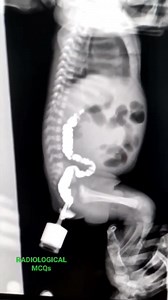 Barium enema study under fluoroscopy #olddelhi #education #radiology #radiologylife #aiims #aiimsdelhi #xray #radiologictechnologist #radiologist | Radiological MCQS