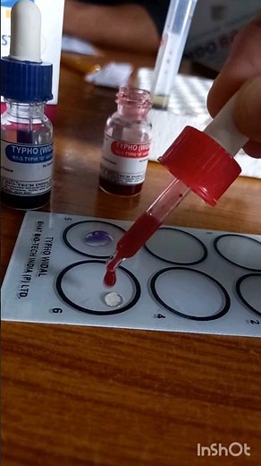 WIDAL TEST PROCEDURE FOR TYPHOID