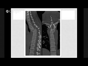Neurocirugía Universidad de Antioquia - Nueva Clasificación Fx toracolumbares AOSpine