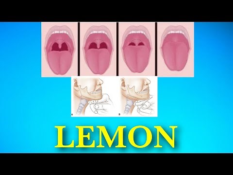 LEMON CRITERIA || AIRWAY ASSESSMENT