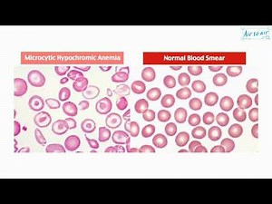 microcytic hypochromic anemia