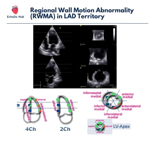 27K views · 281 reactions | 變 Regional Wall Motion Abnormality (RWMA)...