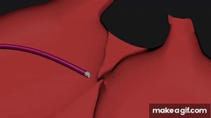 PFO Closure on Make a GIF