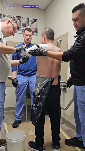 Bilateral Trans-Humeral Prosthetic Casting | Prosthetic Innovations