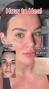 Say goodbye to acne and scarring with this easy micro needling system! Whether you want to get rid of hyperpigmentation, tighten the skin, or reduce acne scarring. Micro-needling is great. The starter kit at banish.com is on sale with over a $70 savings. You'll get products that will help your skin if you get a break out as well. My personal fave is the pumpkin enzyme mask. Use code: SARAHSTARTER at banish.com to get a FREE product with purchase. Or use sarah5 to save $5 on any purchase linked i