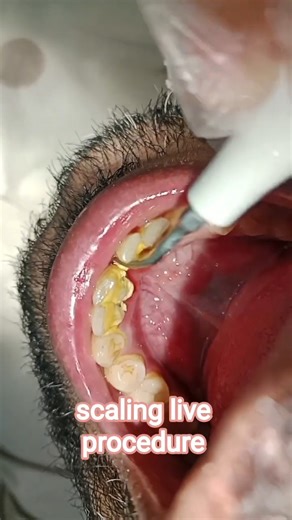 Scaling of Calculus and tator big quantity #shortvideo #dentist #shortsfeed #art #scaling