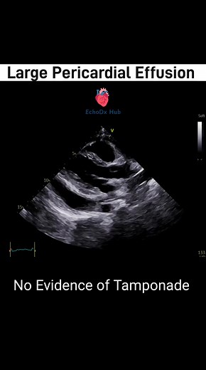 🫀 Large Pericardial Effusion – No Evidence of Tamponade (2D Echo) This video explores the echocardiographic appearance of a large pericardial effusion in the absence of cardiac tamponade, focusing on 2D echo views, clinical significance, and key differentiating features. 🔍 Echo Features of Large Pericardial Effusion: Anechoic (dark) space between the pericardium and heart, circumferentially or posteriorly more prominent Measurement > 20 mm (suggestive of large effusion) Effusion may vary with 