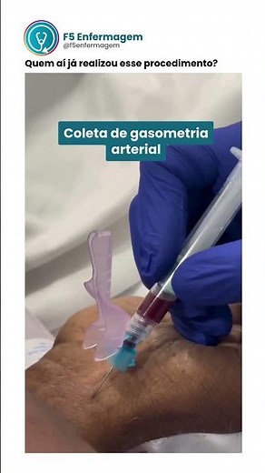 Coleta de gasometria arterial