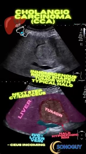 Round mass in the Liver? Think Intrahepatic Cholangiocarcinoma 🔍 🔸 B-mode: ▪️ slightly inhomogeneous round mass ▪️ peripheral hypoechoic halo 🔸 CEUS ⚡ Arterial Phase: Irregular hyperenhancement ⏱️ Early Washout #FOAMed #ultrasound #ceus #liverx | إستشاري امراض الباطنة والكبد د محمد الجمال