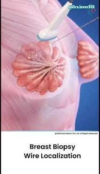 Breast Biopsy With Wire Localization 3DMedical Animation #Shorts#BreastBiopsy#Breast*