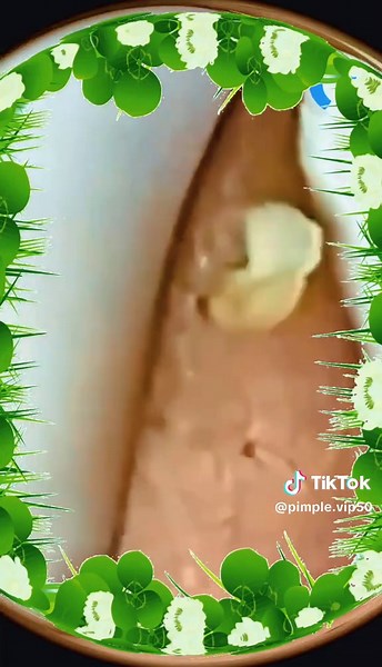 Pimple Popping Compilation | Best Satisfying Blackhead Removal ASMR Skincare 2025 #pimplepopping #satisfyingvideos #nopimplefilter #acnepop #skincareasmr #grossbutgood #realskincare #whiteheadremoval #blackheadpop #closeskincare @Relaxing D Chill @Relaxing D Chill @Relaxing D Chill