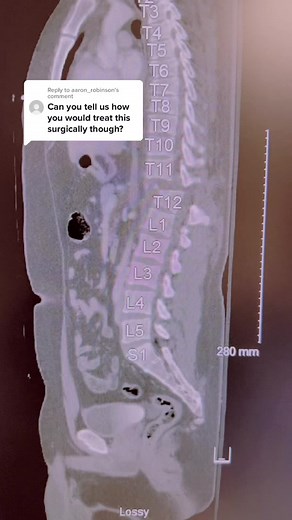 Reply to @aaron_robinson answers for this case #spinefracture | fracture