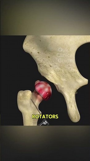 Hip Replacement Surgery Direct Superior Approach #hipreplacement #orthopedics #hipsurgery #hippain
