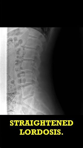 Lumbar Spine Scoliosis: Quick RTG Case Short