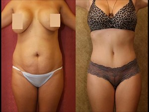 Tummy Tuck Before and After Pictures including abdominoplasty Revision & Mommy Makeover