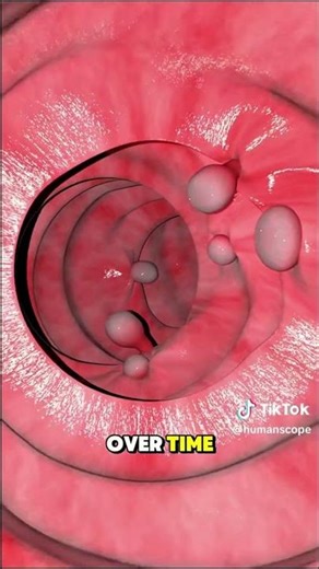 Colonoscopy Secrets: How Doctors Stop Cancer Before It Starts