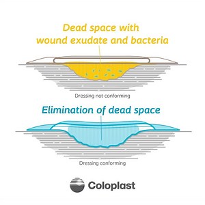 What happens under a wound dressing that CONFORMS to the wound bed versus one that doesn't? Learn in this animation and read more at bit.ly/BiatainSilicone | Coloplast Wound and Skin Care