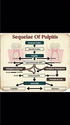 Sequelae of pulpitis /Oral Pathology And Microbiology/# Dream Doctor