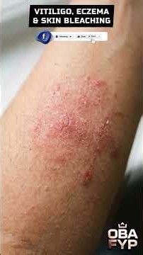 The Truth About White Skin Patches | Vitiligo vs Eczema vs Skin Bleaching Explained.