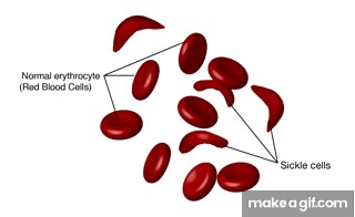 sickle cell anemia on Make a GIF
