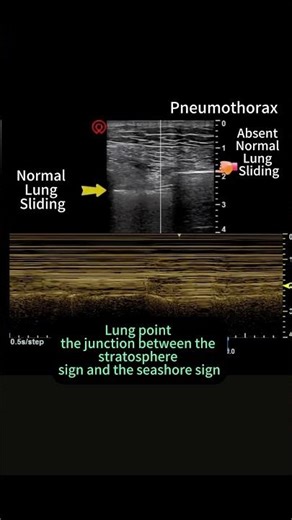 Pneumothorax sonography: Lung Point, stratosphere sign and the seashore sign, lung sliding