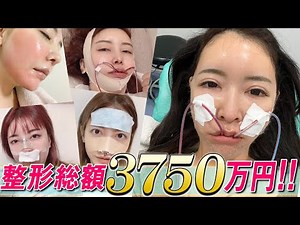 【整形総額】これまで整形に掛けたお金で家が買えちゃいました!!