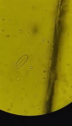 6.9K views · 119 reactions | Urine sample. Female patient, 5 years old. #lablife #medicallaboratoryscience | Lab life | Facebook