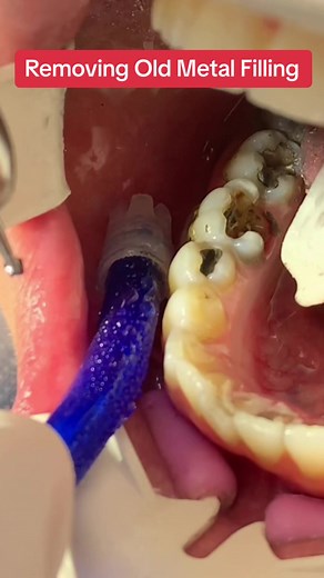 Removing Old Metal Filling