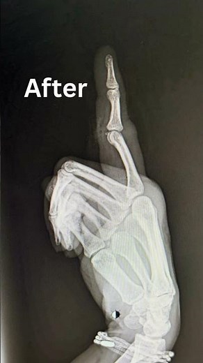 Index finger dislocation | phalanx fracture | close reduction #shortvideo #viralvideo #fracture