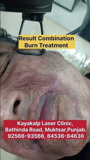 This Burn Scar Technique Works on Everyone #ProvenResults #ScarFading