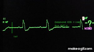 sinus rhythm, third degree (complete) AV block, ventricular escape rhythm on an ECG heart monitor on Make a GIF