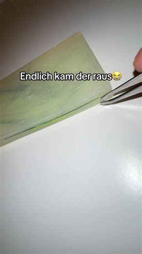 Endlich kam der raus – Tipps für das Entfernen von Pickeln