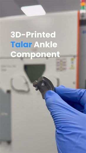 3D-Printed Talar Ankle Component