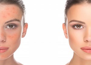 Can Vitamin D Cause or Treat Face Rashes? | LoveToKnow Health & Wellness